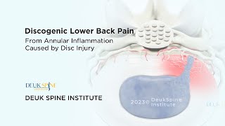 Discogenic Lower Back Pain  3D Animation [upl. by Waldo]