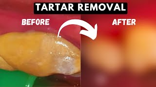 Huge TARTAR REMOVAL From Teeth  TEETH CLEANING [upl. by Ecirtac50]