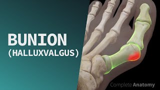 Bunion Hallux Valgus [upl. by Nevear495]