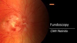 CMV Retinitis Fundoscopy [upl. by Oicor]