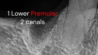 Endodontic treatment Lower premolar 2 canals [upl. by Wincer]