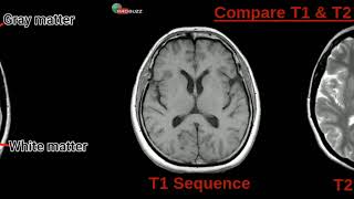 Mri Brain sequences T1  T2  FLAIR [upl. by Lacy17]