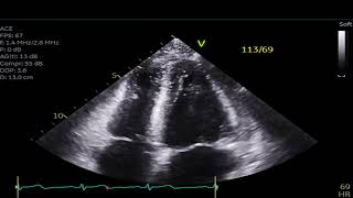 Reverse Stress Cardiomyopathy [upl. by Eachern]