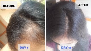 OMG  15 Days Hair Growth Miracle Treatment  Grow Long Thicken Hair  100 works [upl. by Lear]