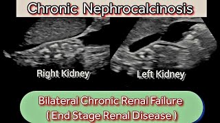 Chronic Renal Disease CKD  Nephrocalcinosis Ultrasound  EndStage Kidneys [upl. by Anicnarf968]