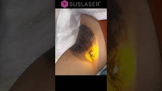 SUSLASER Underarm Carbon Peeling For Underarm Pigment removal amp Whitening [upl. by Oiligriv]