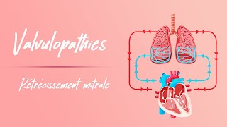 Rétrécissement mitral  Physiopathologie [upl. by Albertina]