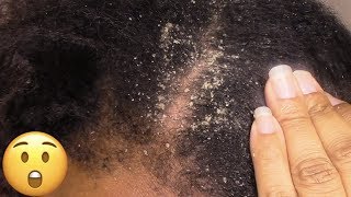 I Found the Perfect Scalp Scratcher Extremely Dry Itchy Scalp Dandruffremoval Satisfying [upl. by Winser]