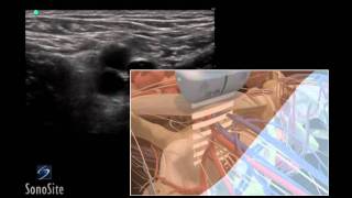 How To Ultrasound Guided Insertion of a Femoral Vein Catheter 3D Video [upl. by Koal385]