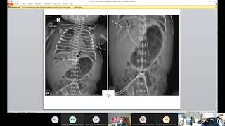 Central Line Care in Neonates [upl. by Animsaj232]