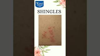 Shingles Best homeopathy treatment Drkukreja kalani online consult8291492566 [upl. by Aieki662]