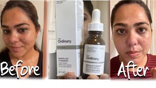 The ordinary 05 retinol in Squalane India Reviewthe ordinary Retinoid for Indian acne skin [upl. by Ney]