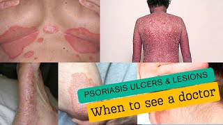 Psoriasis ulcers amp lesions [upl. by Annoek]