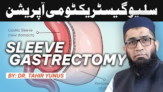 What Is A Sleeve Gastrectomy Effects And Benefits Explained by Dr Tahir Yunus Bariatric surgeon [upl. by Mercedes]