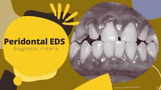 Periodontal EhlersDanlos Syndrome Diagnostic Criteria [upl. by Ahsinit2]