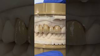 Splinted Zen Enamel and Monet Pure Zirconia EnvisiontecMain envisiontec lsk121shorts teeth [upl. by Hacim]