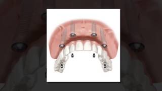 Implant Supported Dentures  Calgary Implant Dentures [upl. by Hasan]