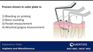 NEET MDS  INICET  Implants and Miscellaneous  Explanatory Video  MERITERS [upl. by New]