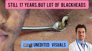 Blackheads extraction in a young male  blackheads blackheadremoval DrAMAZINGSKIN [upl. by Recha903]