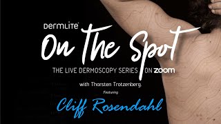 DermLite On the Spot Dermoscopy Series  Dr Cliff Rosendahl [upl. by Stier]