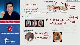 OTORRINOLARINGOLOGÍA Oído externo Cuerpos extraños [upl. by Yrahk]