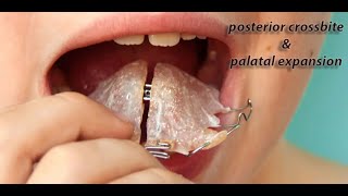 posterior crossbite and Maxillary expansion [upl. by Denman814]