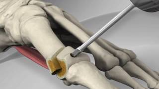 First Metatarsal Distal Chevron Osteotomy with Arthrex® LPS Screw [upl. by Akers]