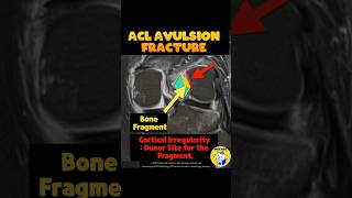 Fig 2B15 ACL Avulsion fracture from the femoral attachment [upl. by Inah178]