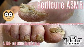 👣Pedicure ASMR on Extremely Calloused Feet👣 [upl. by Yasmeen986]