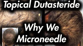 Topical Dutasteride amp Microneedling Why It Helps [upl. by Tj795]