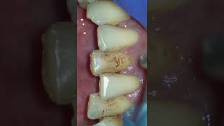 Scaling and Air Polishing using Prophymate teeth teethcleaning teethwhitening satisfying [upl. by Ailimaj]