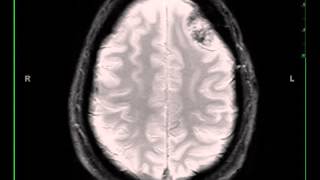 Meningioma left frontal [upl. by Blaseio151]