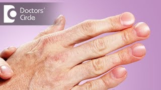 What causes painful horizontal ridges on nails with discomfort  Dr Urmila Nischal [upl. by Tempa]