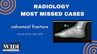 Most Missed Cases Calcaneal Fracture [upl. by Derfla396]