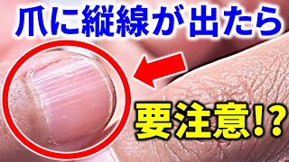 【爪でわかる！】爪に縦線が出たら要注意！？爪でわかるあなたの健康 [upl. by Cris]