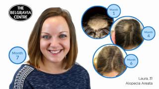 Belgravia Alopecia Areata Treatment Success Story  Laura Full Video [upl. by Greenwald839]