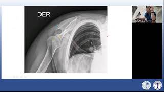 WEBINAR Luxación Posterior de HOMBRO [upl. by Novihc]