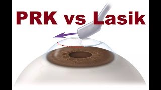 PRK VS Lasik Hindi [upl. by Gertrudis760]