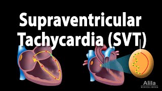 Supraventricular Tachycardia SVT PSVT Animation [upl. by Notgnirra108]