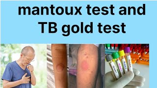 Mantoux test hindi main TB gold test hindi mainTB disease investigation [upl. by Rafaelle565]