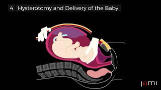 Primary Low Transverse CSection Steps [upl. by Vargas]