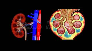 Chronic Kidney Diseases  Animated Atlas [upl. by Kinna260]