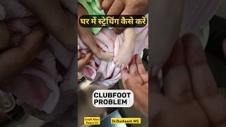 CLUBFOOT Streching at Home🔥 घर में कैसे करना है ctev clubfoot bowlegs [upl. by Tortosa]