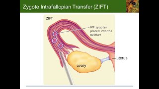 Zygote intrafallopian transfer as a type of assisted reproductive technology [upl. by Aniraad716]