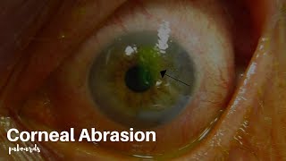 Eye injuries Corneal abrasion [upl. by Whitver837]