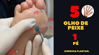 Tudo o que você precisa saber sobre o TRATAMENTO DE OLHO DE PEIXE [upl. by Hayarahs]