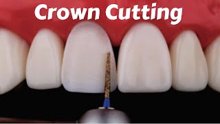 Crown Tooth Preparation Cutting for Anterior Incisor PFM Zirconia Ceramic Emax  Prostho Lecture [upl. by Imiaj]