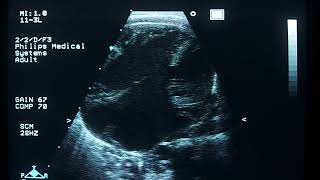 Atrial Septal Defect [upl. by Swain]