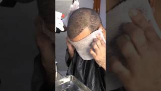 Hair Wash After Hair Transplant New Technique [upl. by Malinowski]