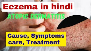 eczema kya hota hai  atopic dermatitis in hindi  skin problem  eczema treatment [upl. by Anaizit]